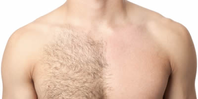 Epilation