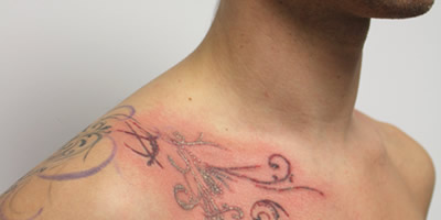 Tattooentfernung